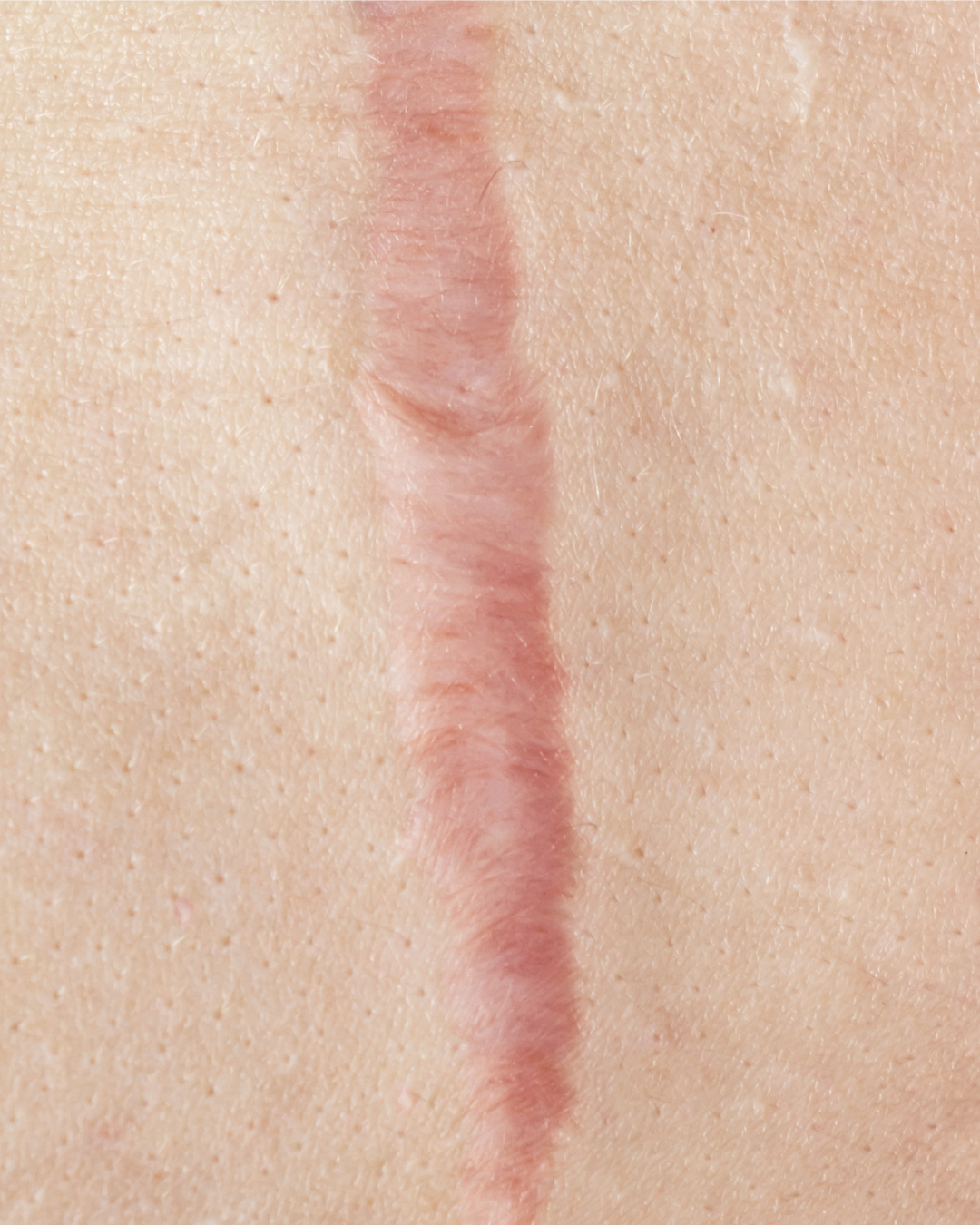 cicatrice ipertrofica